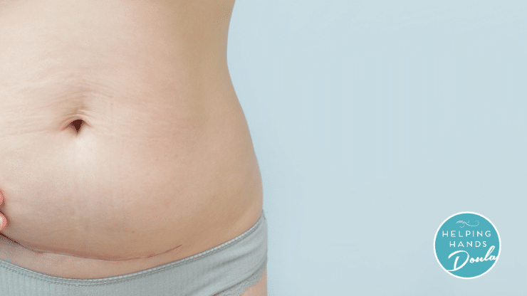Birth Parent with cesarean section scar